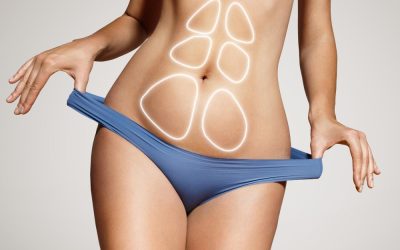 Lipo laser