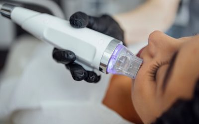 RF Microneedling
